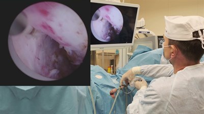 Операция Сорокина Н.И. в МГУ. Тулиевая лазерная энуклеация гиперплазии предстательной железы